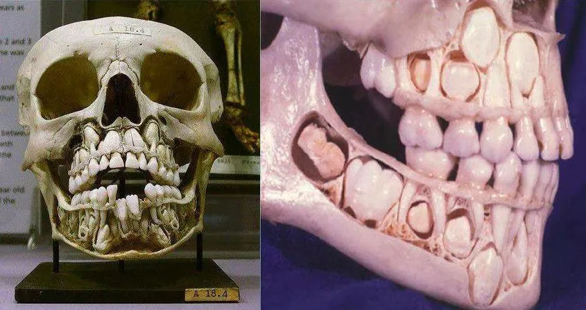 Uncovering Enigma: The untold story behind the mysterious Hunterian Museum specimen