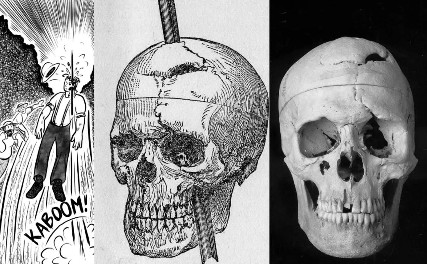 Phineas Gage — The Man Who Lived After His Brain Was Impaled With An Iron Rod!