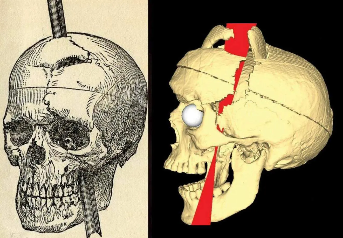Phineas Gage — The Man Who Lived After His Brain Was Impaled With An Iron Rod!