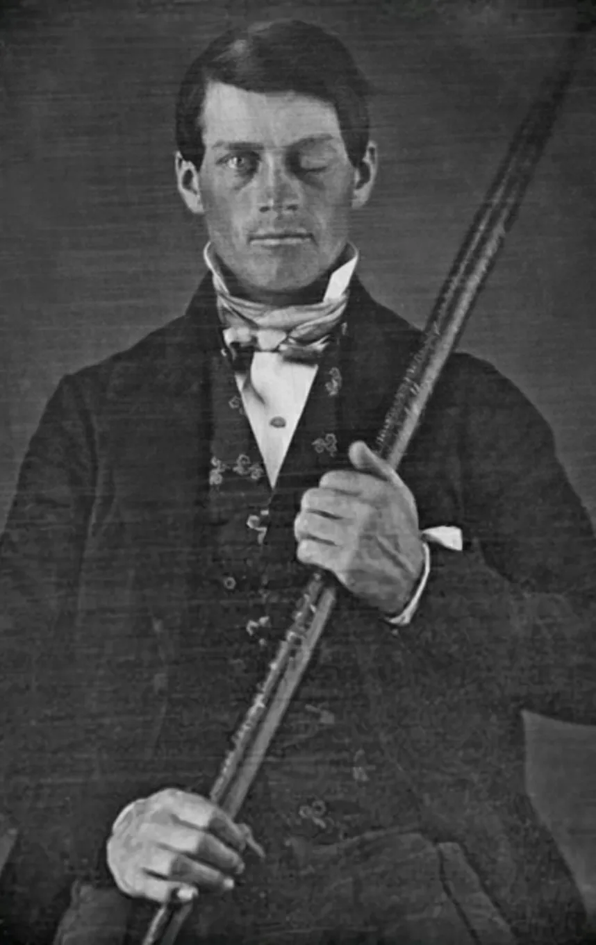 Phineas Gage — The Man Who Lived After His Brain Was Impaled With An Iron Rod!