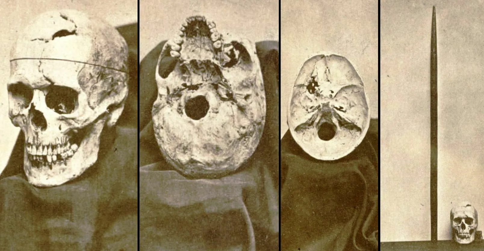 Phineas Gage — The Man Who Lived After His Brain Was Impaled With An Iron Rod!