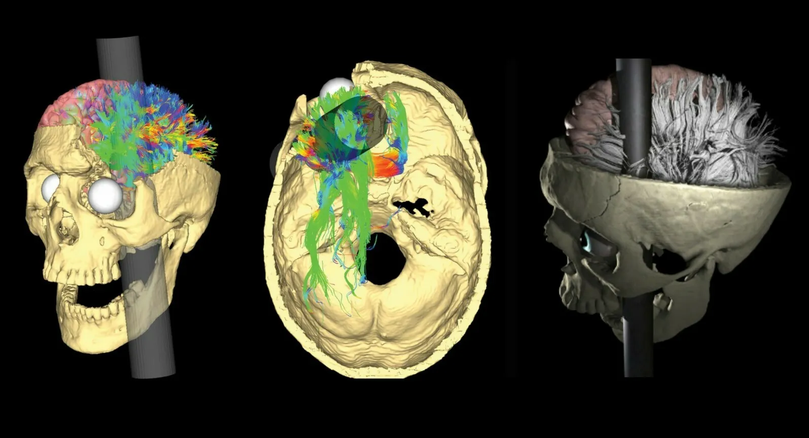 Phineas Gage — The Man Who Lived After His Brain Was Impaled With An Iron Rod!