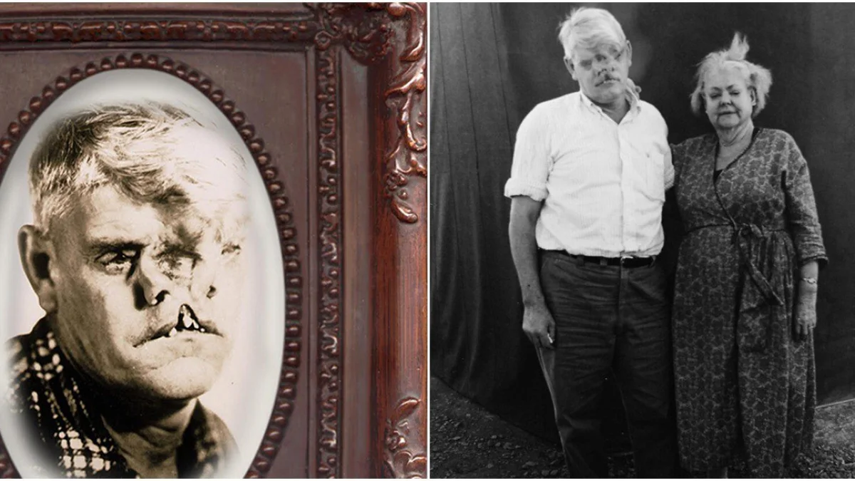 The Tragic Life of the Man with Three Eyes, Two Noses, and a Split Face: An Unwilling Star